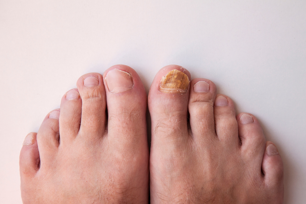 Laser Nail Treatment in  Arlington, VA
